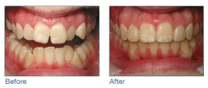 invisalign-before-after