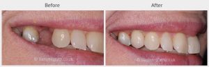 Before and after of a patient with a dental implant